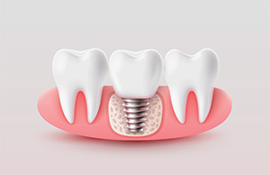 stylized illustration of dental implant tooth restoration - lakeside dental St. Catharines Ontario